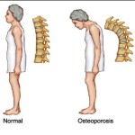 Cara Mencegah Osteoporosis Sejak Dini Dengan Susu Kedelai