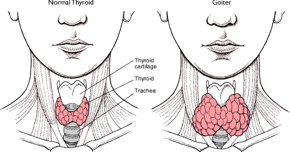 perbedaan gejala klinis hipertiroid dan hipotiroid