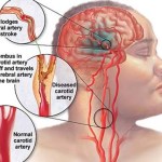 Apakah Penyakit Aneurisma Otak