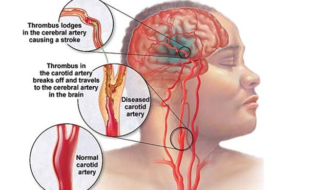 apakah penyakit aneurisma otak
